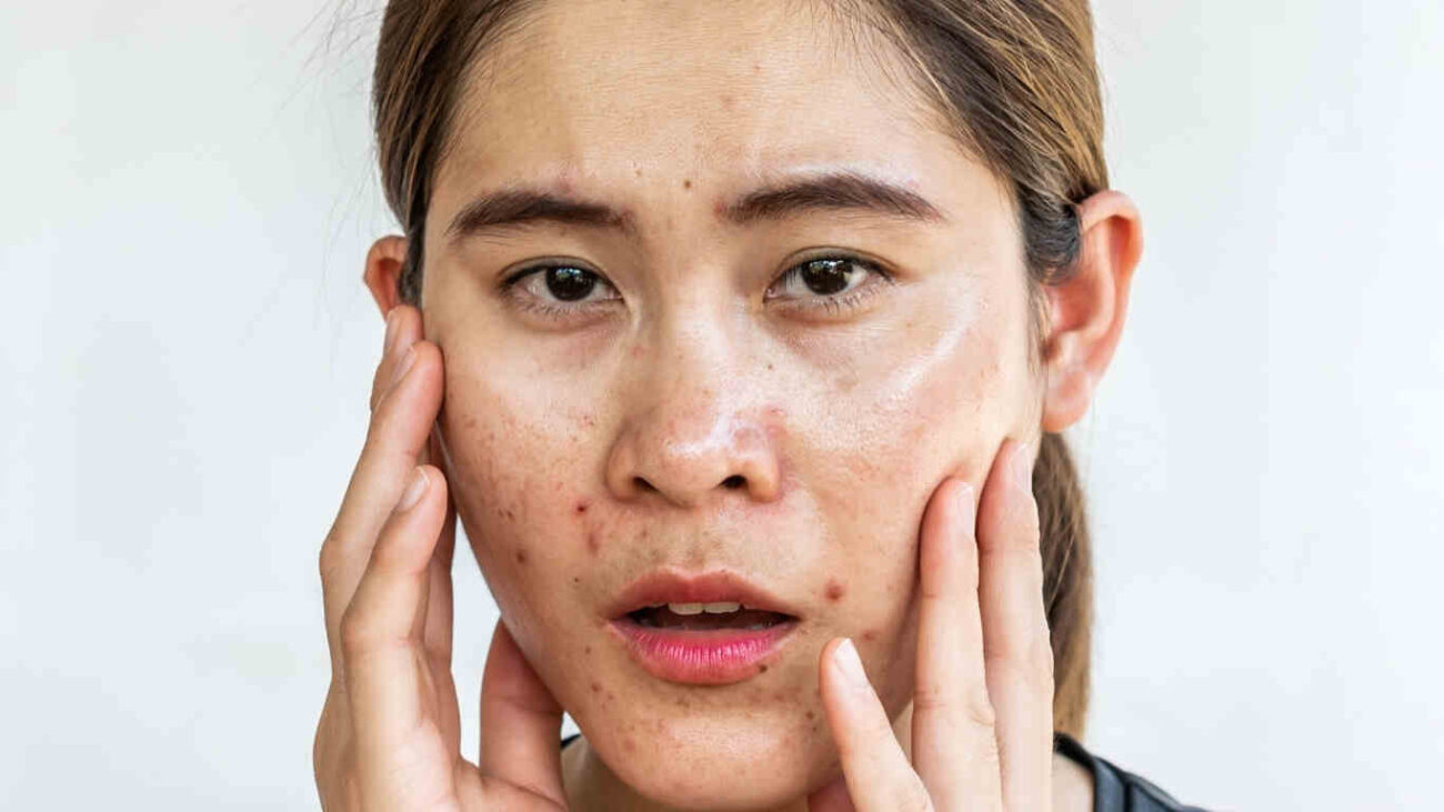 a girl with acne problem