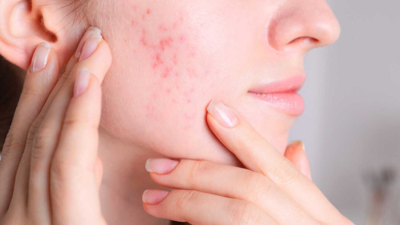 best serum for acne with price in Pakistan